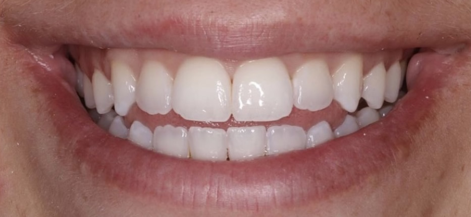 Teeth Whitening Staines upon Thames | Tooth Whitening Treatment